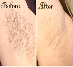 💎脇脱毛1回✮ ✔︎自己シェービングお願いします。