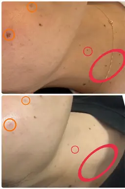 📣低周波のシミケア💎(シミ•イボ•ホクロ対応)1か所¥500⭐️カウンセリング必須(¥0)