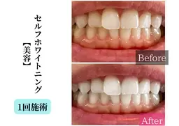 【ピュアホワイトニング】白い歯で自信溢れる笑顔に♪お子様にも◎ 《初回限定💫特別価格》