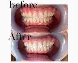 【話題のセルフホワイトニング🦷✨】1回で効果を実感✨透明感のある輝きへ🪥🦷¥3000