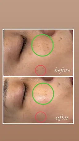 【ニードルピーリング】🌿剥離しない乳酸ピーリングとマイクロニードル、高濃度ビタミンA.C導入！毛穴、ニキビ、シミケア✨