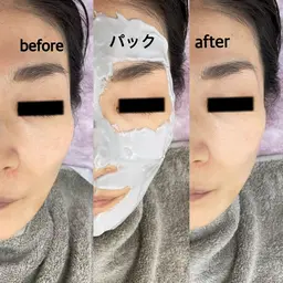 【ニキビケア×シミケア】全顔毛穴洗浄+ビタミンC微弱電流導入+モデリングパック+ミニモ限定高保湿クリーム¥7500