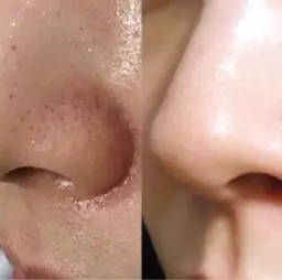 【毛穴洗浄】脱いちご鼻!皮脂/角栓/黒ずみ/ざらざら/ごわつき/テカリ改善!毛穴洗浄でツルツル肌!《ミニモ限定》