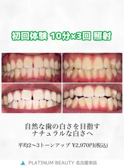 【平均2​〜​3トーンアップ】　SNS映え◎お試しセルフホワイトニング✨〈15分×2回〉