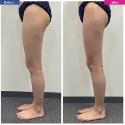 【初回】｟足痩せ｠脱セルライト❗️スラっと美脚💃下半身ダイエットコース【お尻・太もも・ふくらはぎ】