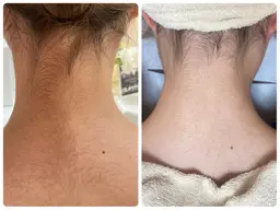 【うなじ脱毛】時間内で対応のシェービング付き！💚日焼けなどの予定がある際は3​〜​4日ほど前にご来店ください☺️✨