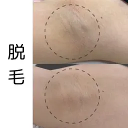 2部位✨夏に向けて⛱️IPL脱毛で♡ツルツル肌&美白♡脇乳輪鼻下手指が人気❤️‍🔥