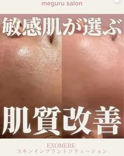 【日本初上陸】✨️肌管理 EXOMERE(エクソミア)〔ターンオーバーを28日から3日に！〕