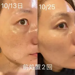 【話題のセルマン】🫧本格韓国ピーリングつや玉肌体験🫧 [兵庫県尼崎市/痩身エステ]