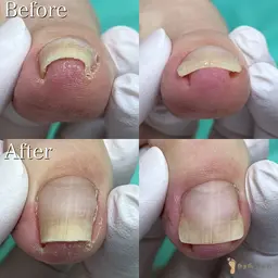 【巻き爪補正】1爪の巻き爪補正✨痛い💥巻き爪は早めのケアが大切💡形が気になる方もご相談ください💁🏻‍♀️