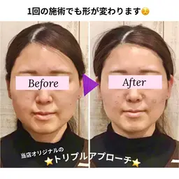 【肌の代謝❤️‍🔥美肌育成に⭕️】フル小顔矯正＋毛穴洗浄🫧＋ラジオ波で毛穴もフェイスラインもキュッと上がる👰‍♀️