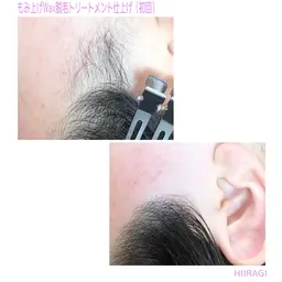 もみ上げ脱毛（ブラジリアンwax脱毛）トリートメント仕上げ✨