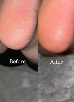 かかと 角質ケア