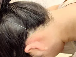 うなじ脱毛2回セット