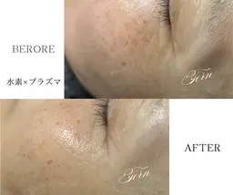 【特許取得施術】細胞レベルからエイジングケア/水素×プラズマ 極上フェイシャル体験