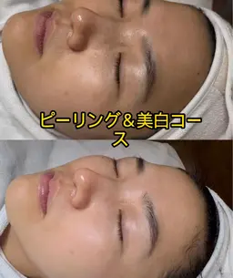 今話題🩷剥離なしヒト臍帯血ハーブピーリング🩷 ツヤツルツルふんわり肌へ❤️‍🩹毛穴洗浄＆美白コース込み¥ 3980