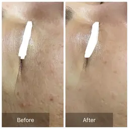 【特に目元が気になる方】ハーブピーリング🌿.∘