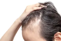 薄毛や抜け毛の根本改善💈⚗️お薬で無理矢理生やすのではなく根本を改善💡ヒト幹細胞培養上清液導入(前頭部M)