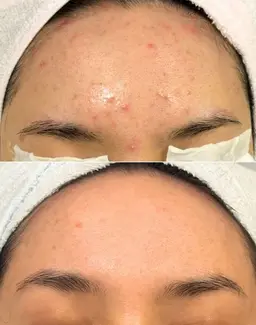 ハーブピーリング 男性