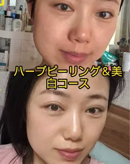 今話題🩷剥離なしヒト臍帯血ハーブピーリング🩷ツルツルふんわり肌へ❤️‍🩹毛穴洗浄＆美白コース込み ¥ 3980