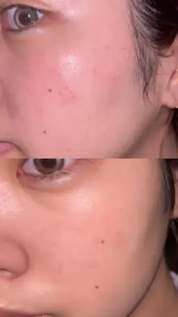 【ニキビ撃退】REVIハーブピーリング集中ケア