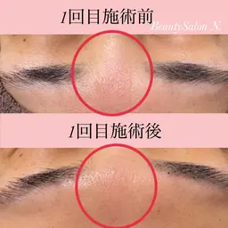 REVI ハーブピーリング🌿陶肌パウダー2g ＋オプション1gお肌に負担をかけずにターンオーバーを促し肌質改善