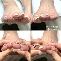 【片親指】🌸巻き爪矯正