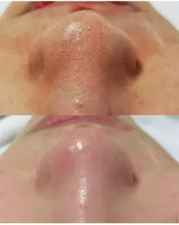 【黒ずみ毛穴/ニキビケア/角質除去】毛穴掃除コース