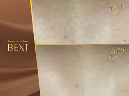 【結果重視】全身脱毛＋VIO＋うなじ＋顔（レディース）or ヒゲ（メンズ）｜痛みが不安な方にも◎名古屋駅・ささしま近く