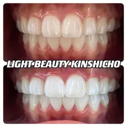 【オススメ】１日集中 ２０分×２照射 黄色く着色汚れのある歯を綺麗で自然な白さへ🦷✨