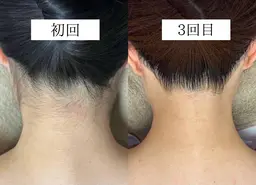 【学割！成人式や前撮りに】顔脱毛＋うなじ脱毛