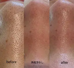 【徹底毛穴ケア】韓国毛穴洗浄+EMS(引き締め改善)+美ツヤ肌アンプル導入