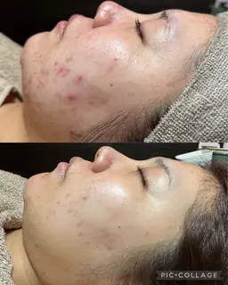 繰り返すニキビ　黒ずみ毛穴　にオススメ🩷🩵剥離なし　REVI陶肌トリートメント（ハーブピーリング）