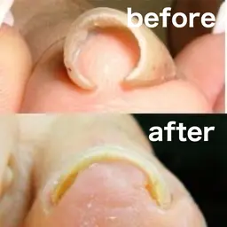 巻き爪補正１箇所　初回限定