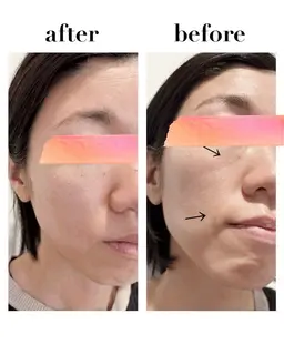 【ミニモ学割】ニキビ肌・毛穴・くすみ改善✨フェイスラインをスッキリさせたい方にもオススメ✨光フェイシャル✨2回体験