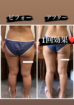 💎究極の部分的痩せ💎10000ショットボディ💎美容整体のサービス付き🥰