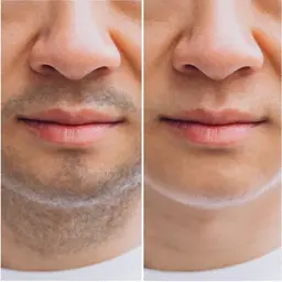 メンズ髭脱毛！その場で青髭卒業‼️最新の光脱毛で効果実感◎鎮静クリーム付き¥3500