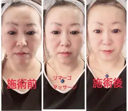【しわ、たるみ、老化が気になるあなたに必見】ミラクルウェーブ （しわ、たるみケア）フェイシャル＋コラーゲンマシン４０分