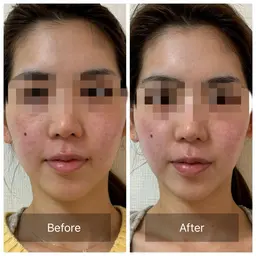 夕方まで！〈選べるフェイシャル〉お試し 30分 くすみ、小顔、たるみ、しみ、光ケア