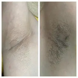 メンズ、レディース同一価格！ワキ脱毛☆