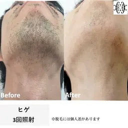 メンズ脱毛【ヒゲ】