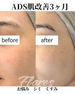 💎【限定10名】本気の肌質改善モニター🌿シミ・毛穴・ニキビケア✨