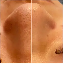 【平日限定!毛穴洗浄】ハイドロスプラッシュ☆ ご新規5,980円→4,000