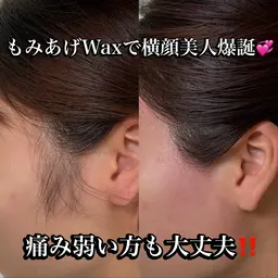 【全顔】おでこ・もみあげ・口周り・頬フェイシャルワックス脱毛🫧シェーバーでは取れない2mm以下の毛を根こそぎ取ります