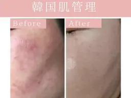 ［今月限定　水光肌🉐セット　ハイドラフェイシャル＋フェイシャルワックス］25000円→9800円