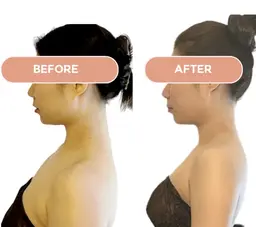 二の腕スッキリモニター募集　美容整体+ウィンバック+上半身リンパ（二の腕集中）1ヶ月に3回来れる方！写真撮影OKの方募集