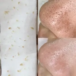 毛穴エクストラクションで毛穴の黒ずみ、詰まりが劇的改善！