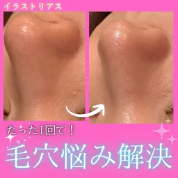 【ハイドロフェイシャル🫧】毛穴の汚れを水流で優しく吸引⚡️透明感をだしてみずみずしい卵肌へと導く💎