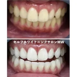 【ご新規様★人気No.1】ハイパワーコース🦷✨​〜​初回限定超集中コース​〜​(15分×3照射)