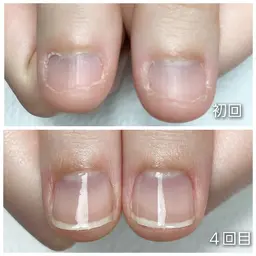 美爪育成ケア(１回)お試しコース